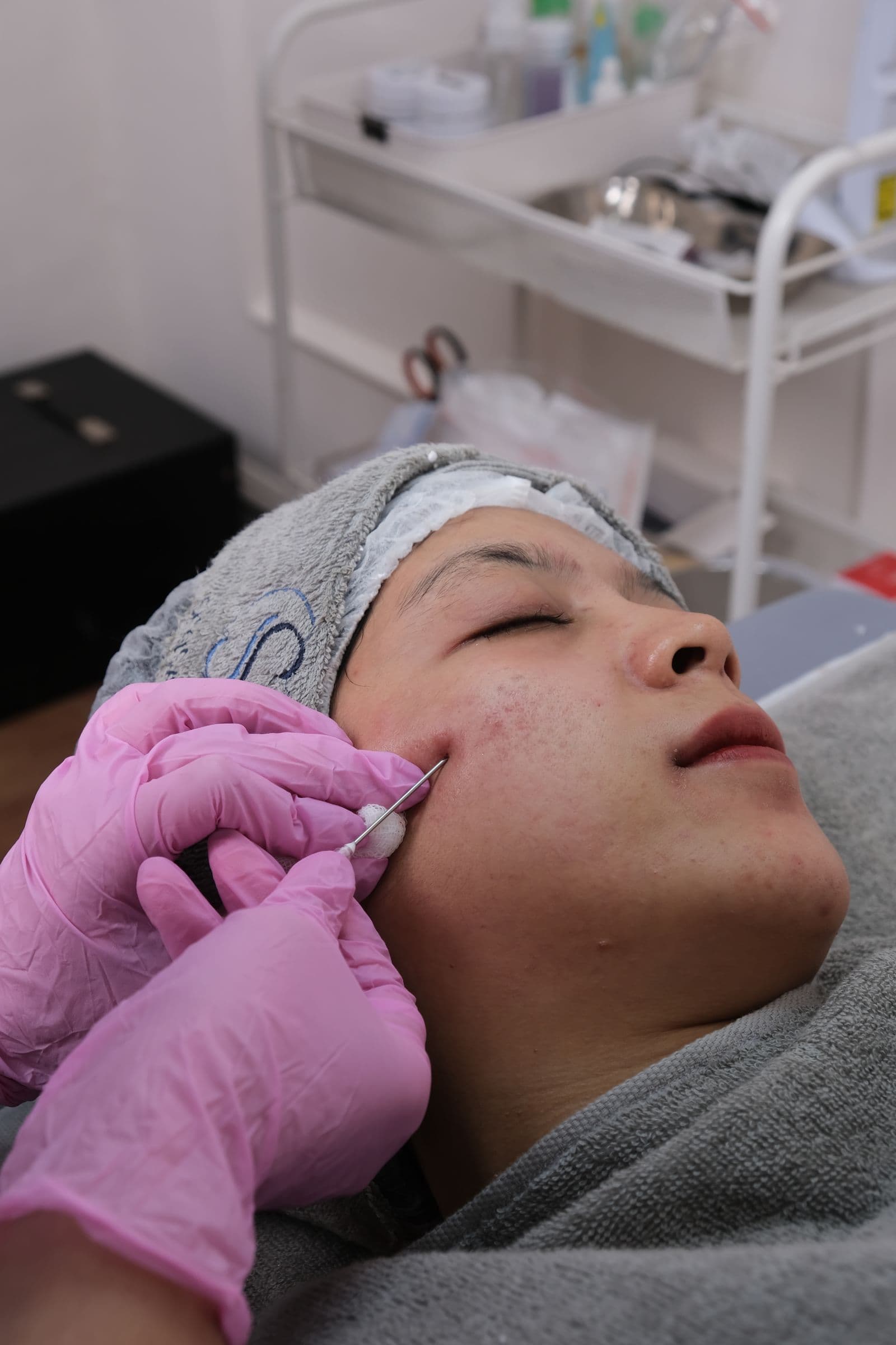 Acne Facial